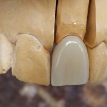 Coroana dentara integral ceramica Emax