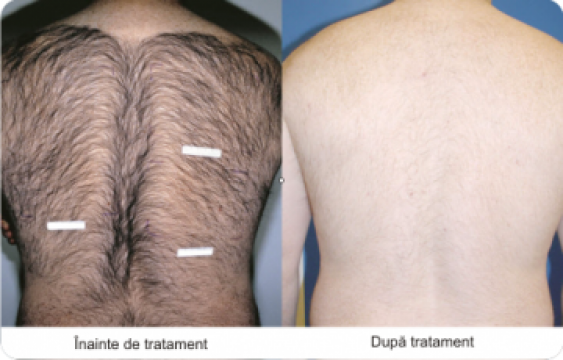 Epilare definitiva laser