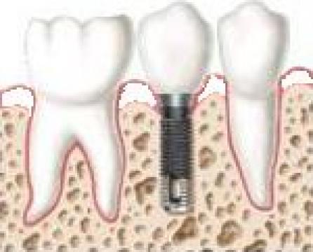 Implant dentar