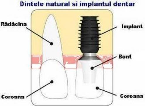 Implanturi dentare Bicon made in USA
