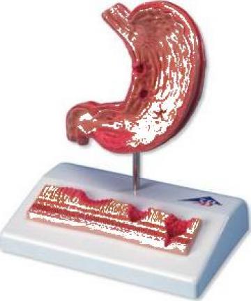 Mulaj stomac cu ulcer