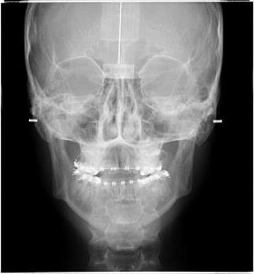 Radiografie de craniu frontal (PA/AP)