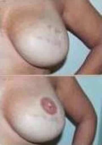 Tatuaj de corectie, de camuflaj, refacere areola mamara