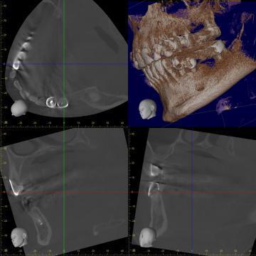 Tomografie 3D (CBCT) pentru un singur cadran 1, 2, 3 sau 4