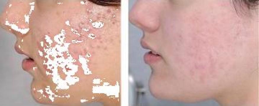 Tratament dermato-cosmetic acnee activa